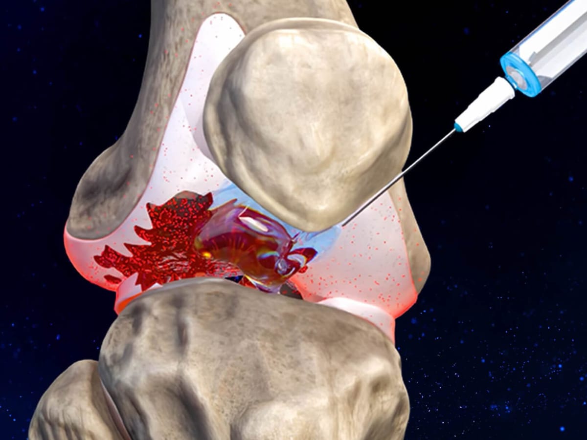 Can a Single Therapy Actually Delay Joint Replacements by a Decade?
